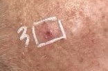 Squamous Cell Carcinoma My Skin St Pete My Skin Bradenton