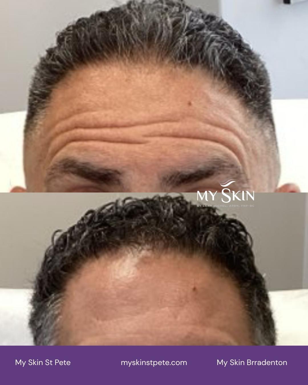 My Skin St Pete My Skin Bradenton Anti wrinkle injection Botox