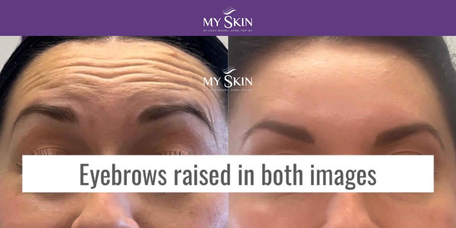 Botox Eyebrow Lift My Skin St Pete My Skin Bradenton