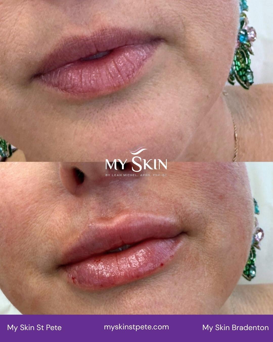 Lip Filler before and after My skin st pete my skin bradenton Lip Filler before and after My skin st pete my skin bradenton