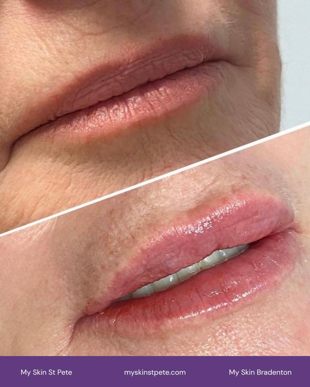 Lip Filler before and after My Skin St Pete My Skin Bradenton Lip Filler before and after My Skin St Pete My Skin Bradenton