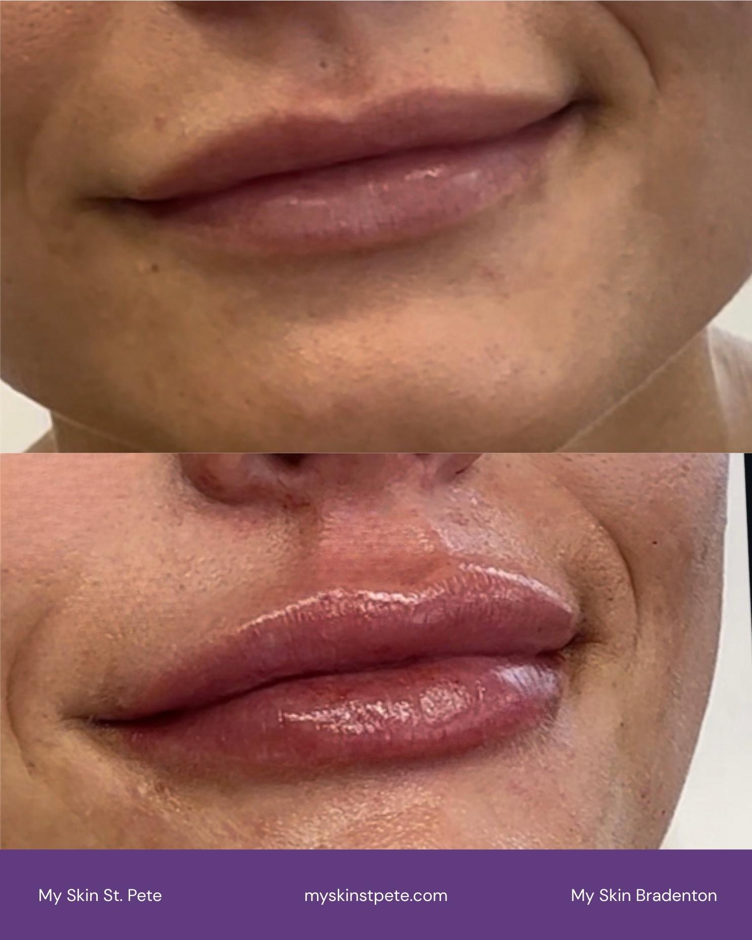 Lip Filler before and after My Skin St Pete and My Skin Bradenton Lip Filler before and after My Skin St Pete and My Skin Bradenton