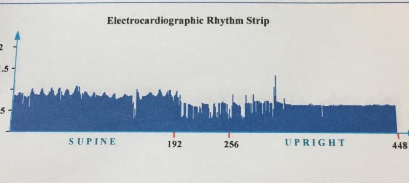 HRV patient before earthing