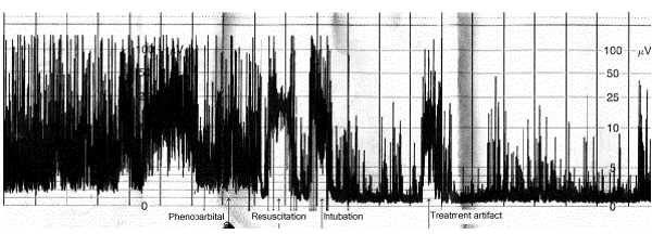 NICU aEEG neonatal patterns seizures artifacts medication NICU aEEG neonatal patterns seizures artifacts medication