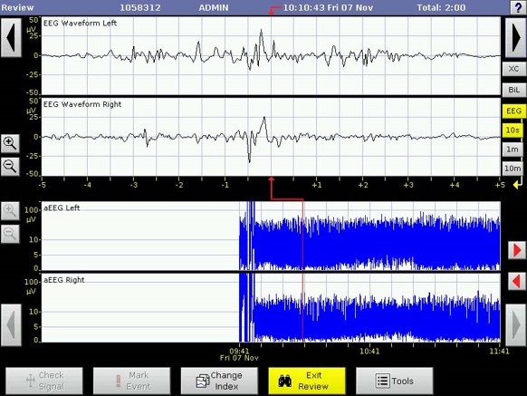 neonatal aEEG discontinuous normal voltage premature infant pattern neonatal aEEG discontinuous normal voltage premature infant pattern