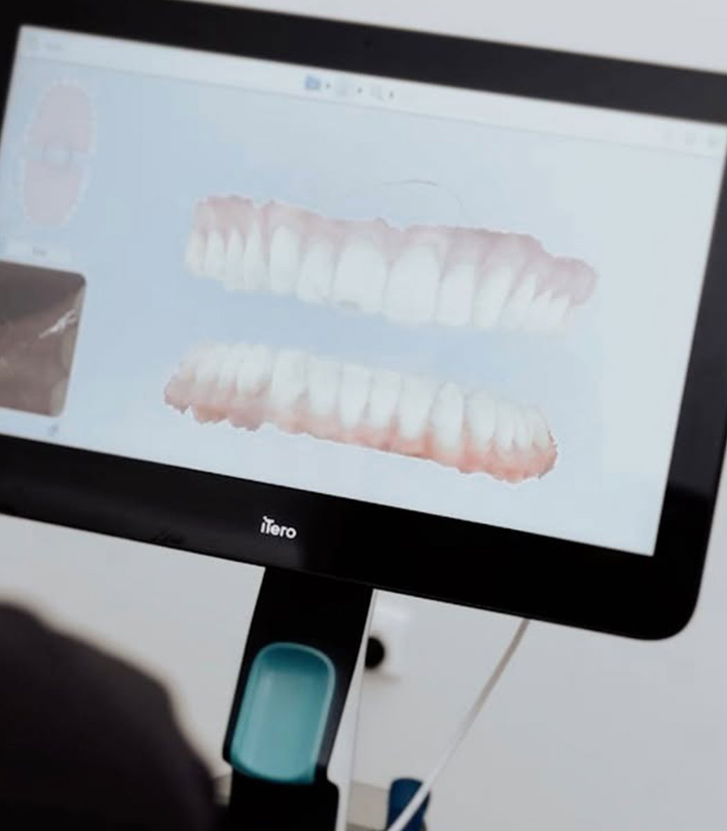 Clear Aligners