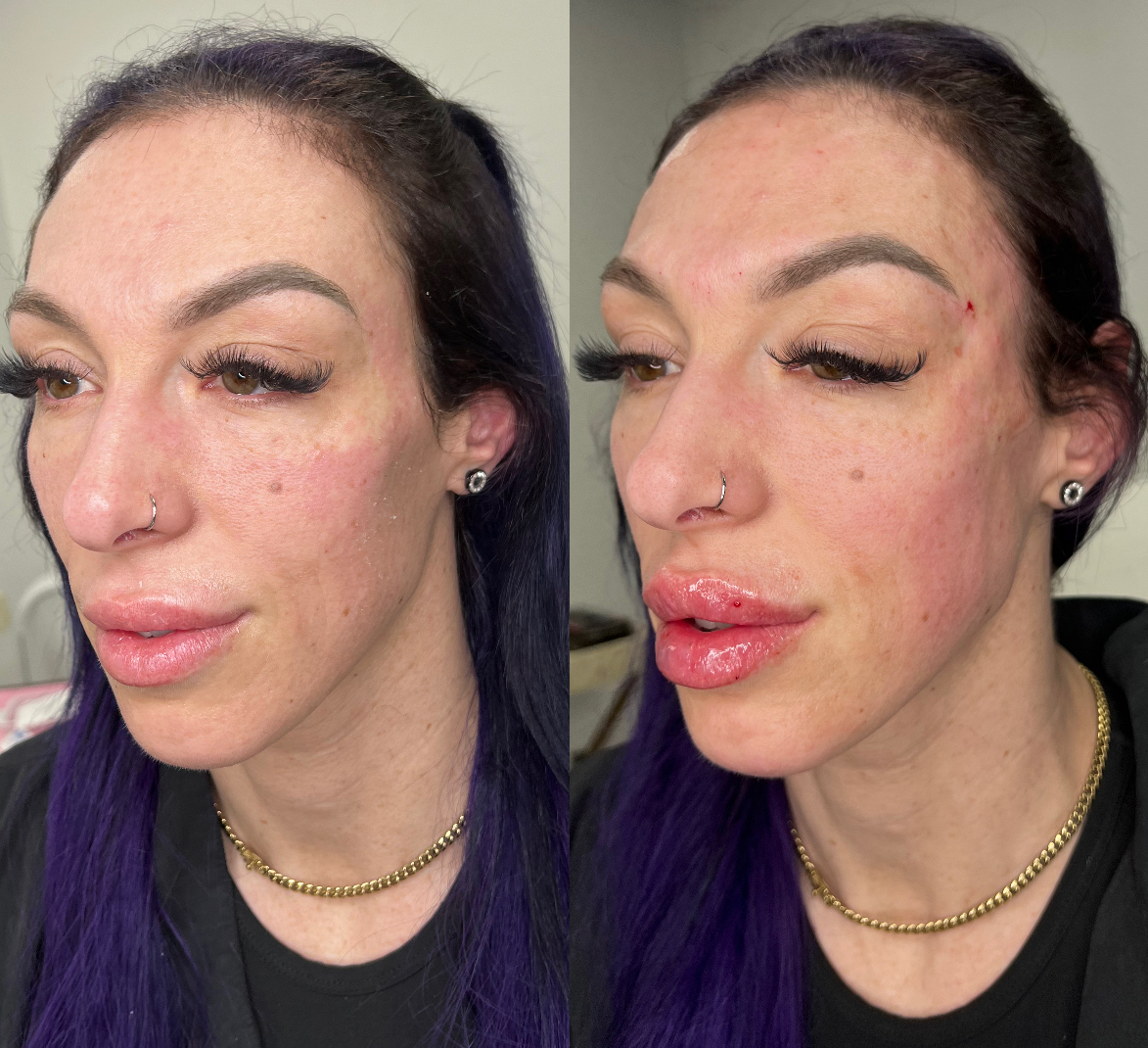 Lip_Fillers_Becky_Does_Botox Lip_Fillers_Becky_Does_Botox