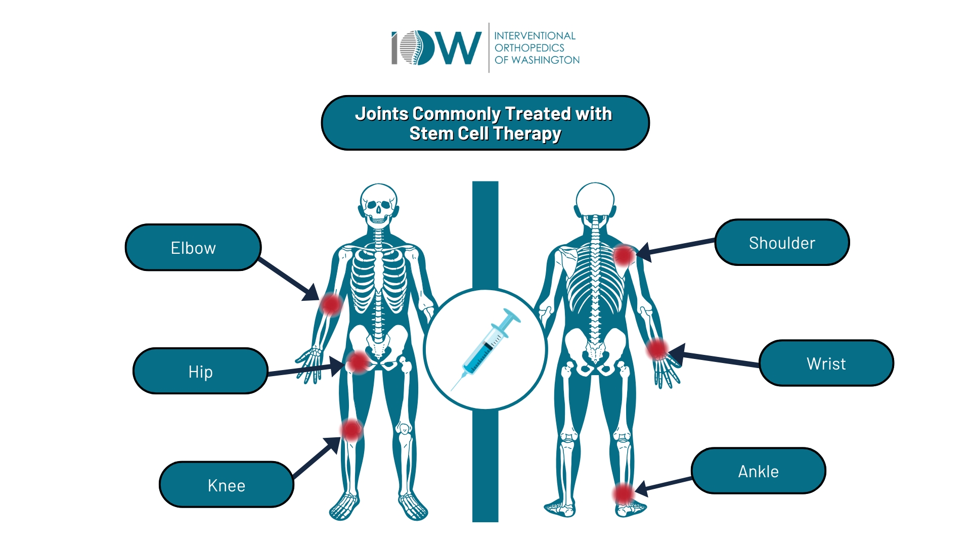 Joints commonly treated with Stem Cell Therapy