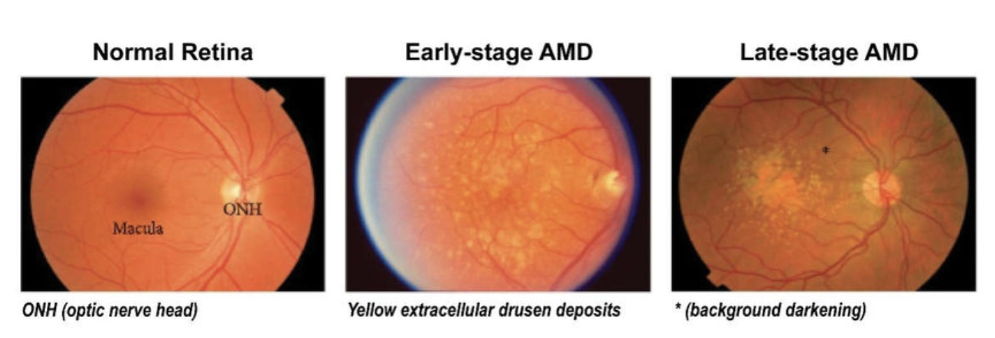 Stages of Dry Macular Degeneration