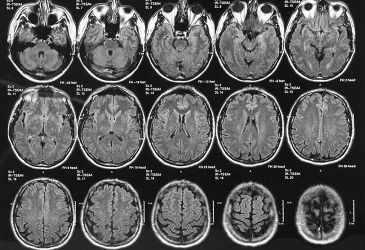 Scans of a brain with disrupted neurotransmitters due to chronic alcohol use. Scans of a brain with disrupted neurotransmitters due to chronic alcohol use.
