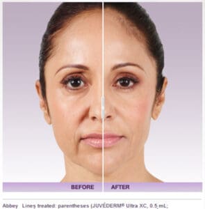 How long does Juvederm Facial Filler last? | Marietta Medical Spa How long does Juvederm Facial Filler last? | Marietta Medical Spa