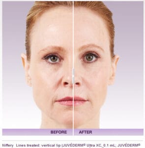 Juvederm Facial Filler Before And After Photos | Marietta Med Spa Juvederm Facial Filler Before And After Photos | Marietta Med Spa