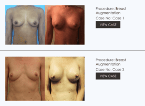 breast-augmentation-surgery-photos breast-augmentation-surgery-photos