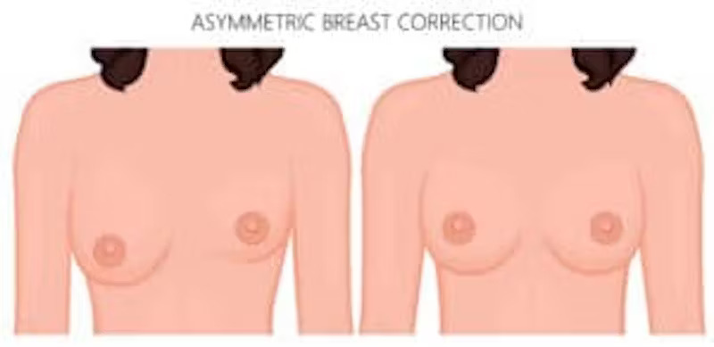 what-can-be-done-about-asymmetrical-breasts what-can-be-done-about-asymmetrical-breasts
