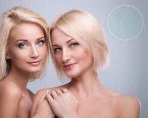 dimpleplasty-dimple-surgery-before-after-photos dimpleplasty-dimple-surgery-before-after-photos