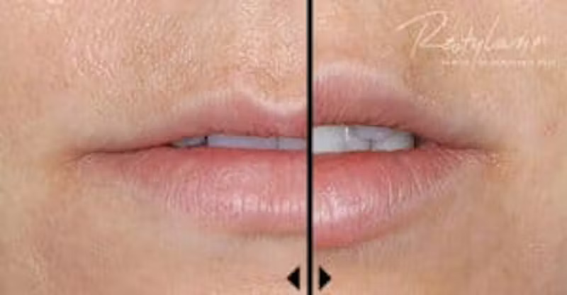 restylane-dermal-filler-photos restylane-dermal-filler-photos