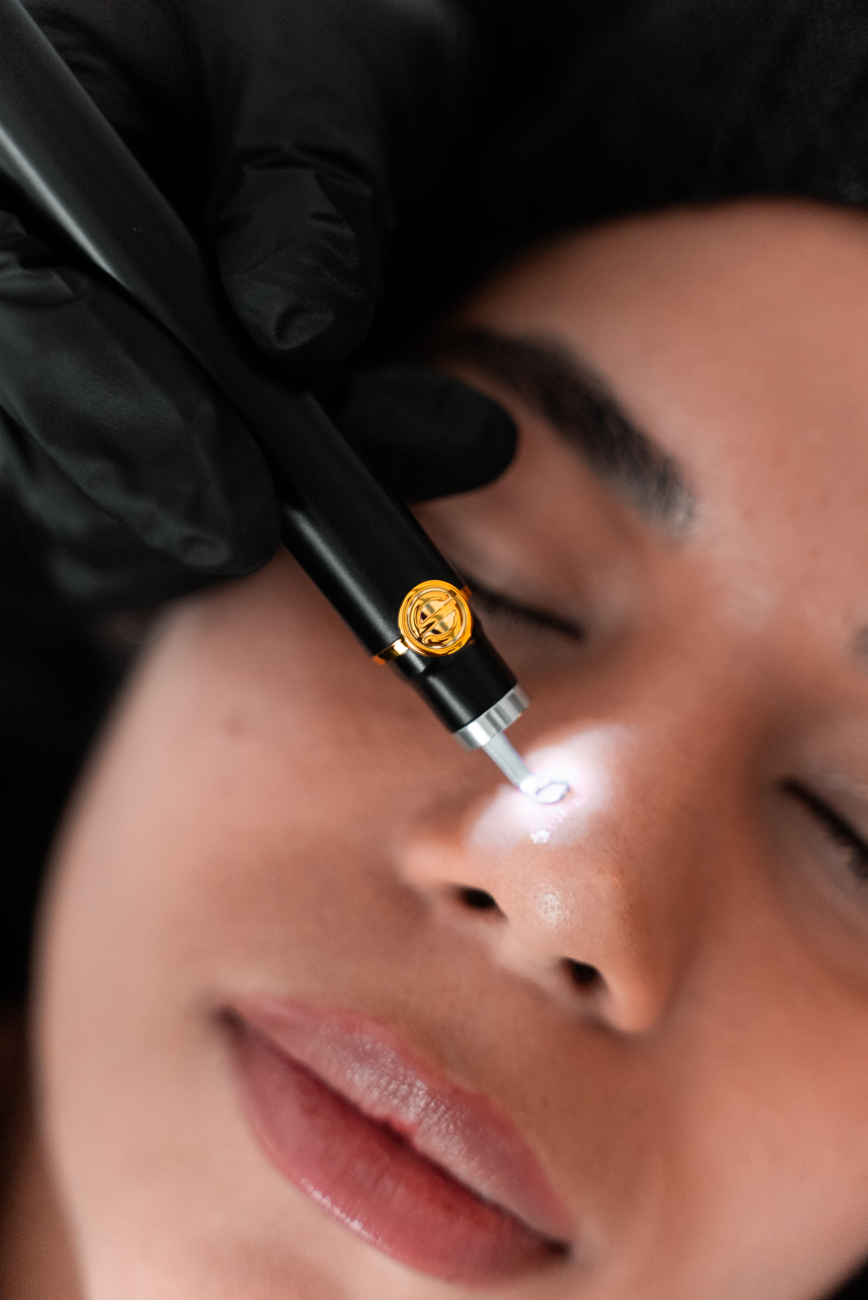 Peeling Químico