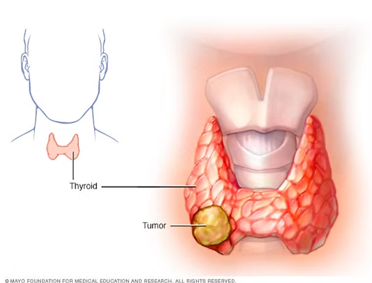 cáncer de tiroides