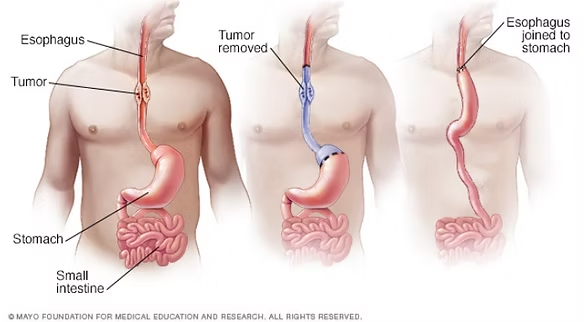 cáncer de esófago