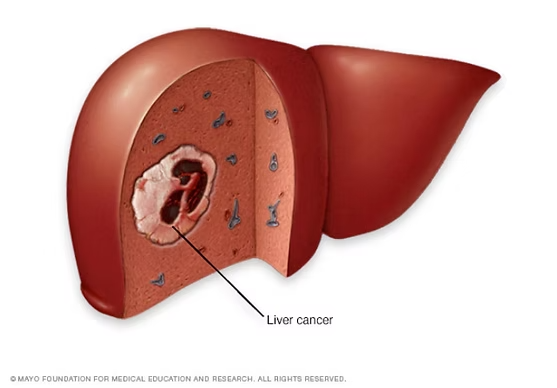 cáncer de hígado