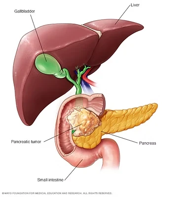 cáncer de páncreas