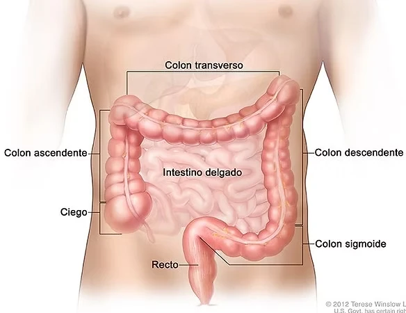 cáncer colorrectal
