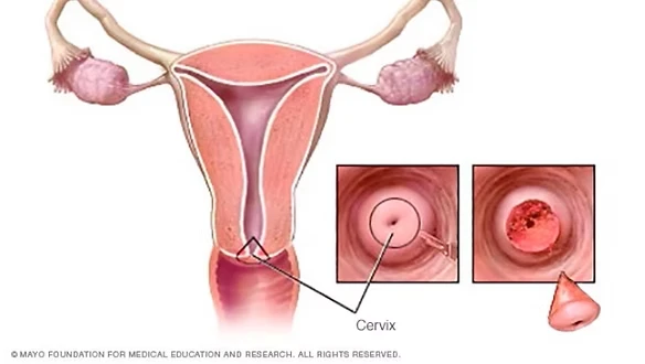 cáncer de cuello uterino