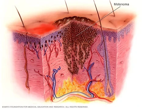 melanoma imagen 1