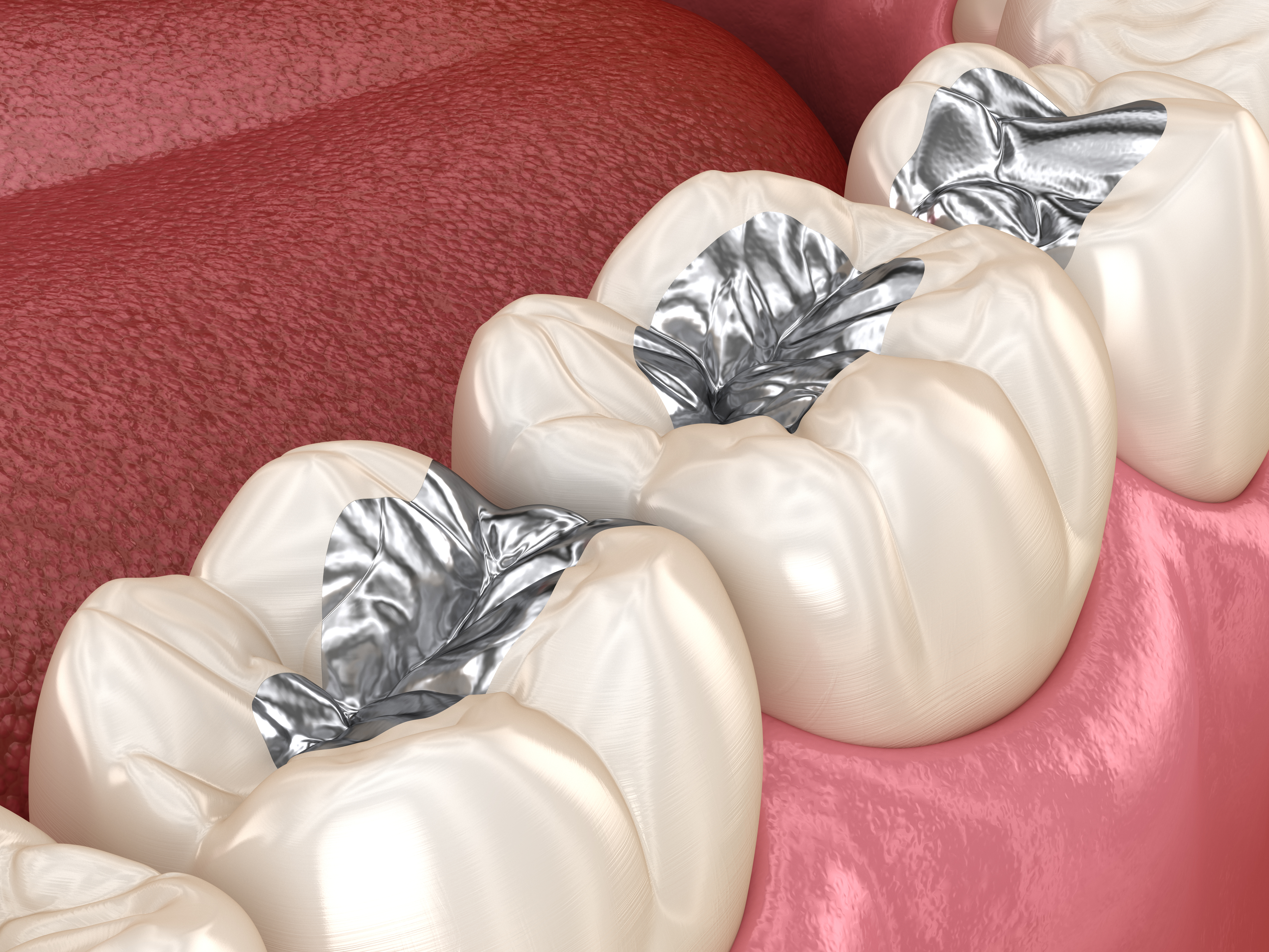 Silver amalgams - heavy metal toxicity Silver amalgams - heavy metal toxicity