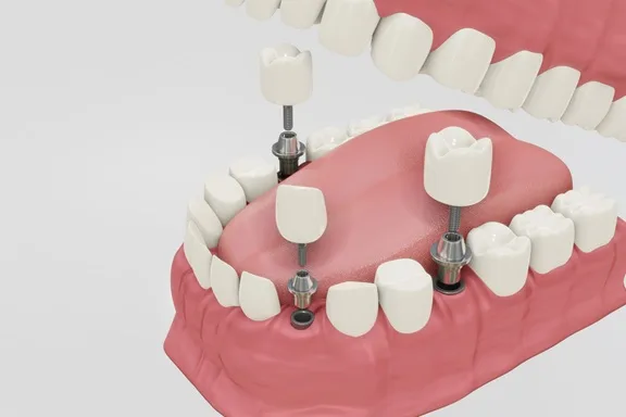 Single Tooth Dental Implant