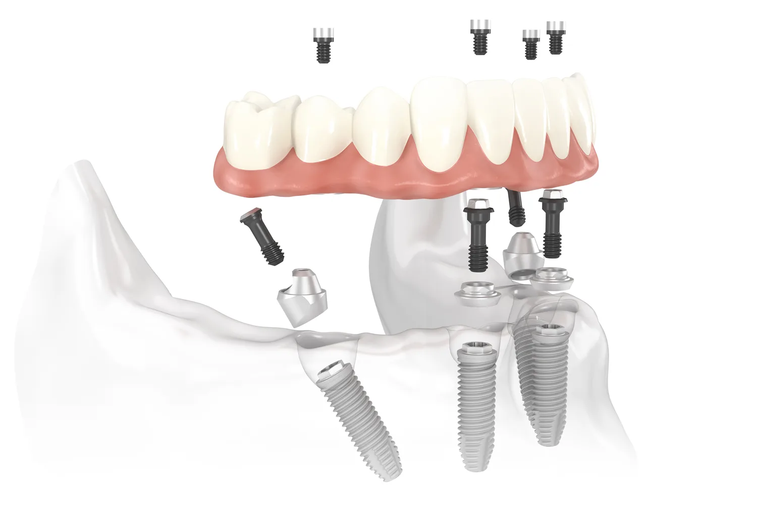 All-on-4 Dental Implants