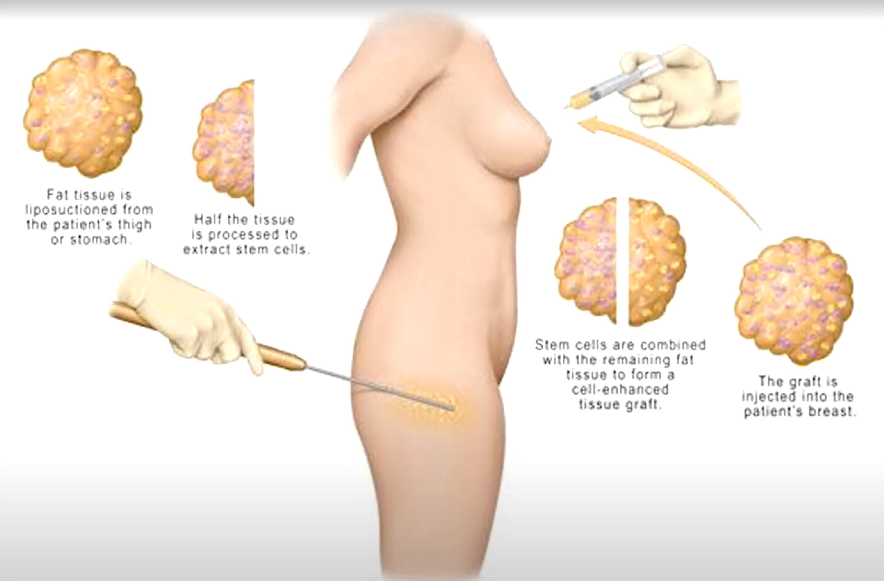 A natural boob job? Surgical implants vs. fat transfer breast enlargement –  the debate explained