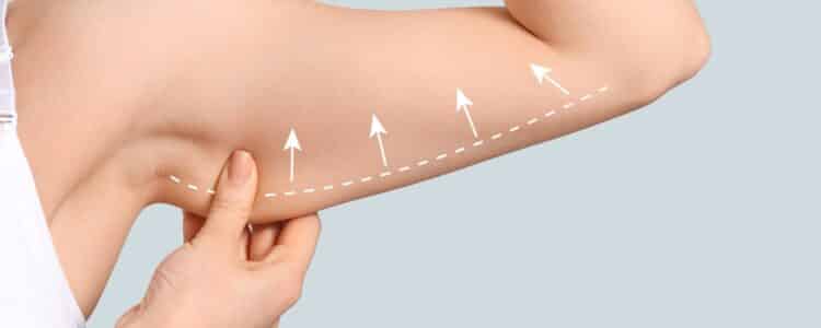 Arm Liposuction in Salt Lake City: What You Need to Know Before Surgery Arm Liposuction in Salt Lake City: What You Need to Know Before Surgery