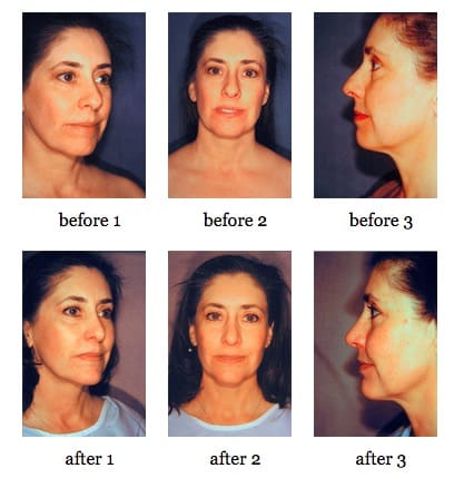 Cheek Implants and Chin Implants Cheek Implants and Chin Implants