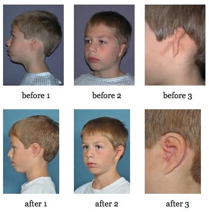 Ear Reconstruction for Microtia Ear Reconstruction for Microtia