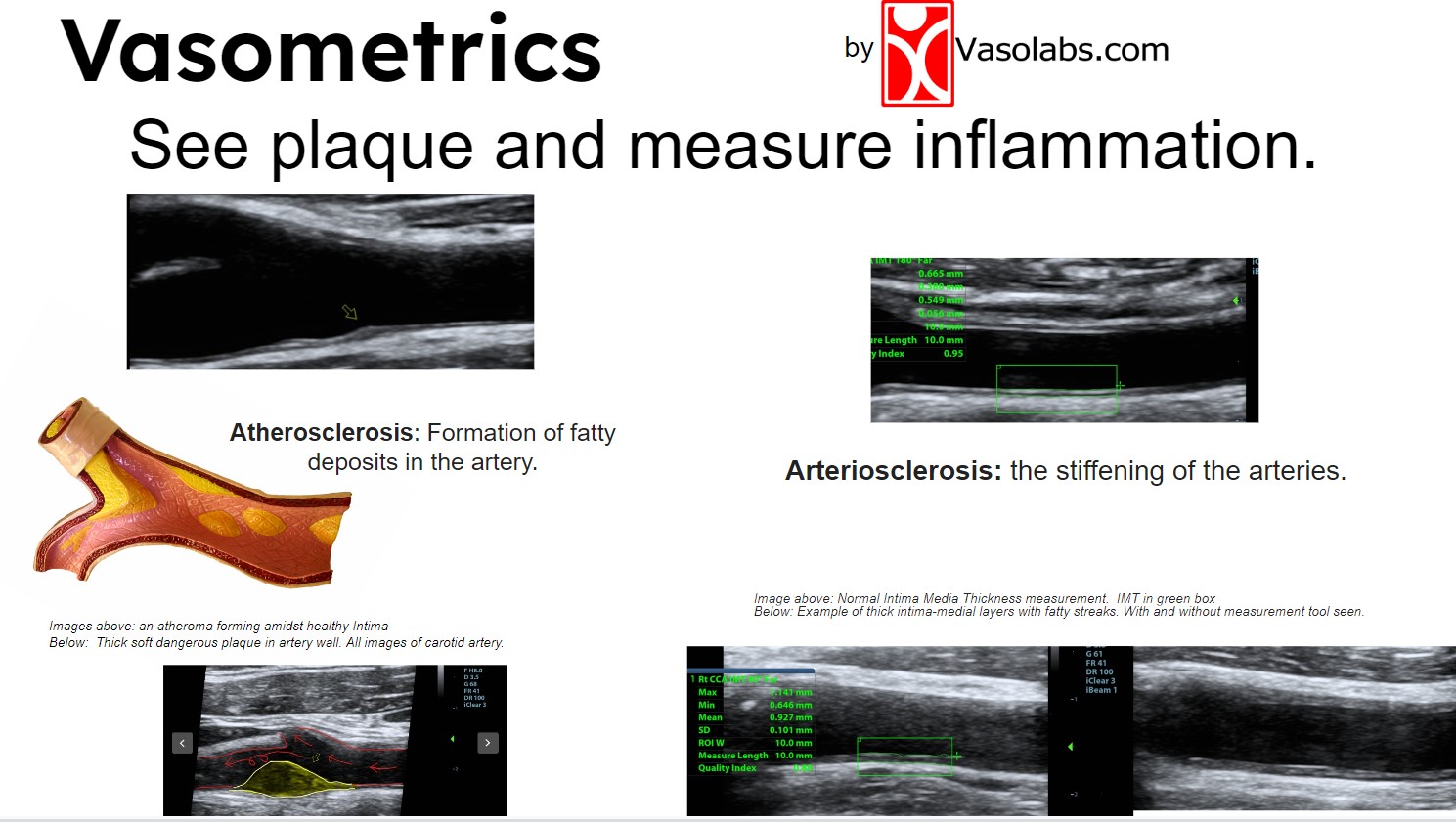 Understanding Your Carotid Artery Scan Results: A Patient's Guide