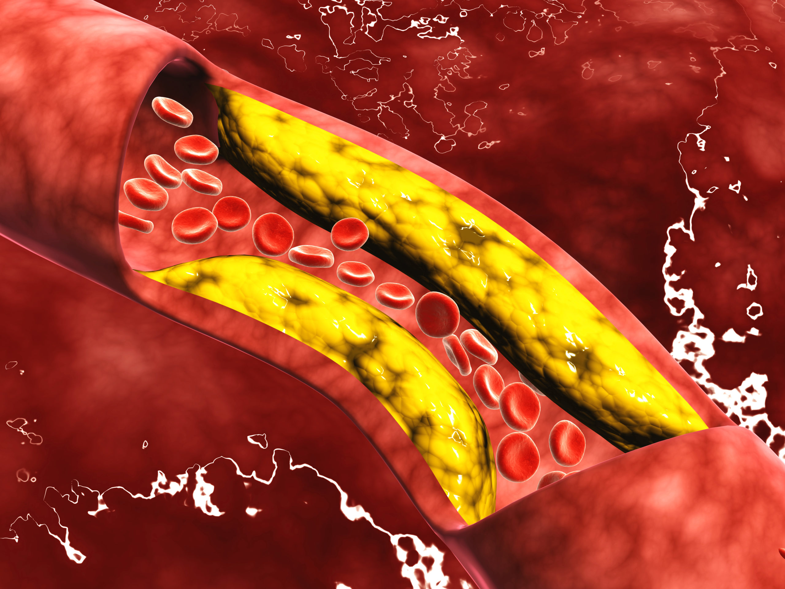 arterial plaque, cimt