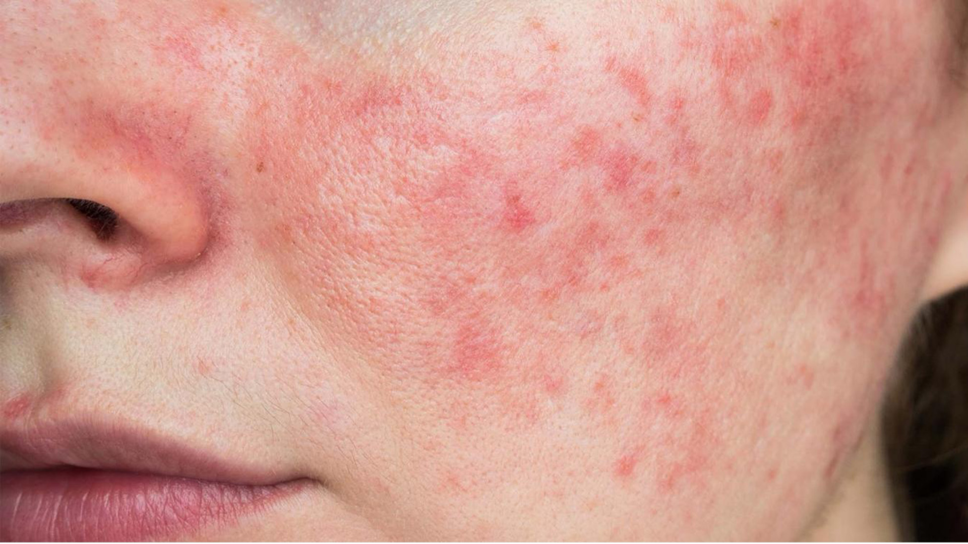 What Is the Best Treatment for Rosacea in Australia?