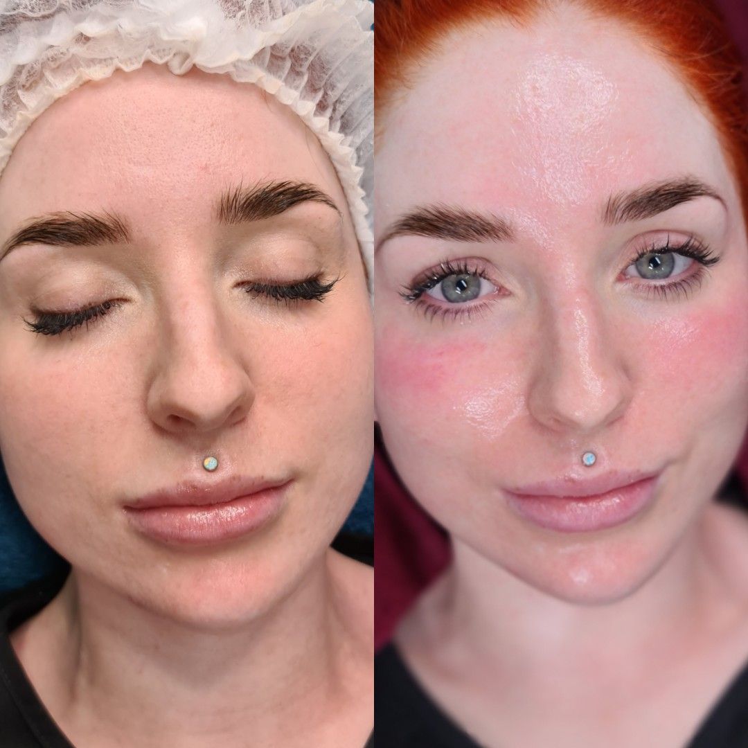 before and immediatley after our bespoke o cosmedics facial