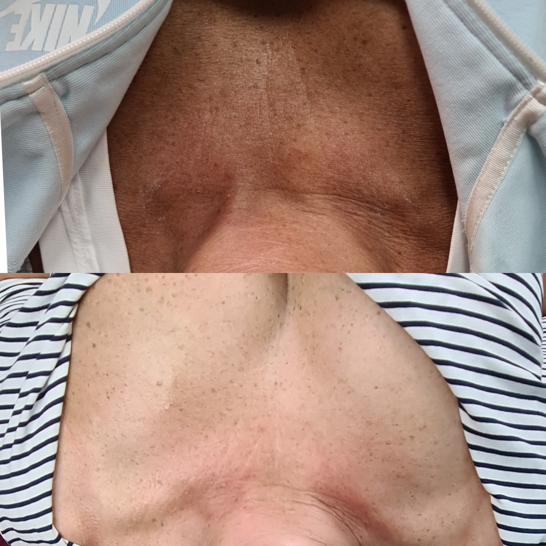 before and after of treating pigment with dermapen on neck and chest at feather touch aesthetics moonah