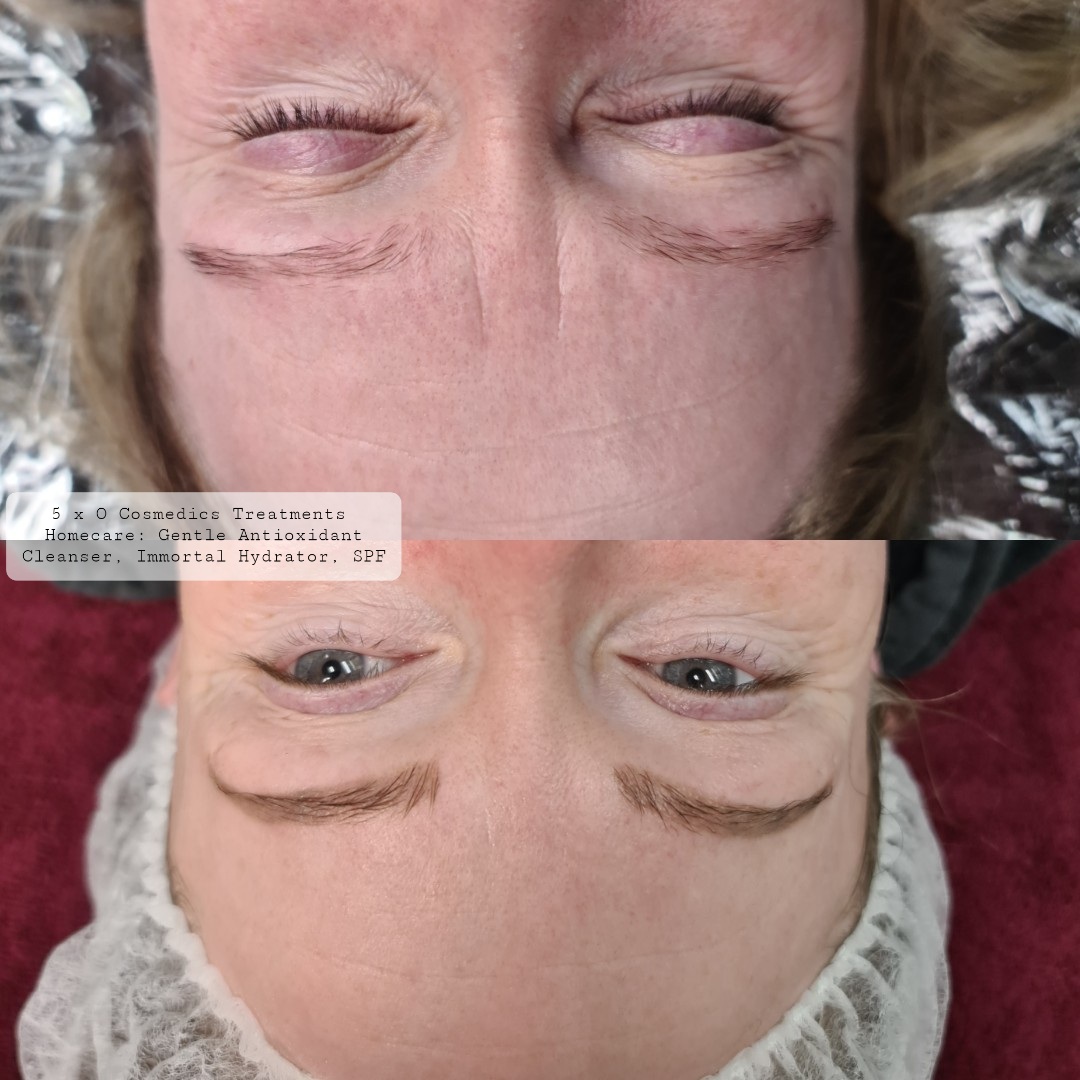 Before and after image showcasing the remarkable skin transformation achieved with O Cosmedics Pro Dermal Peels at our Hobart clinic.