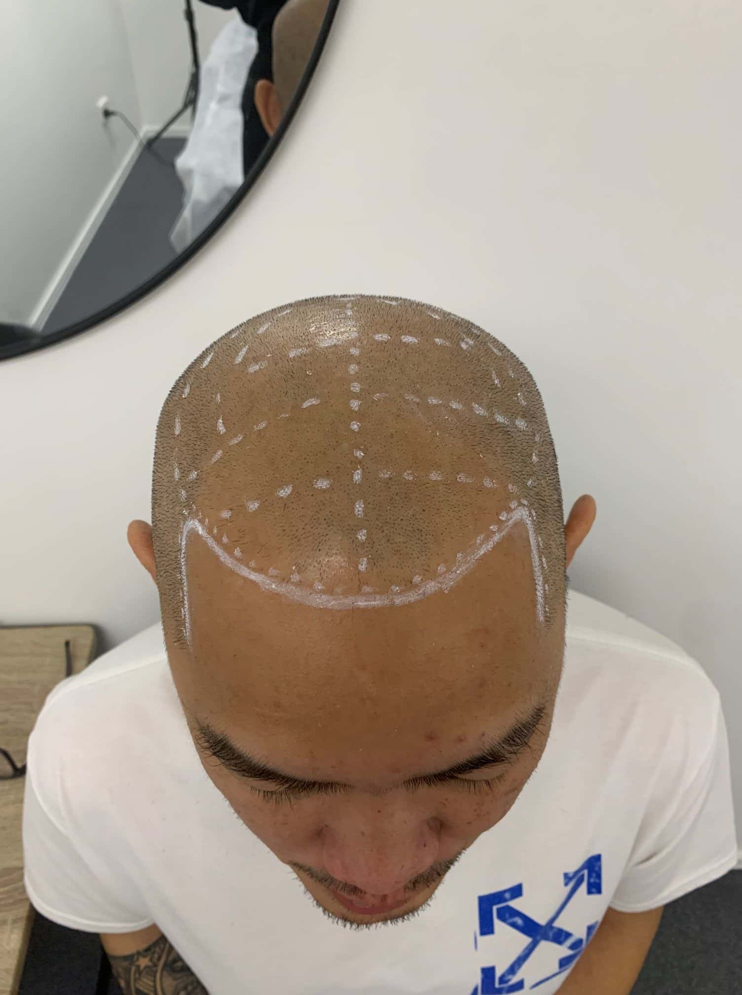 SMP hair loss treatment drawn lines