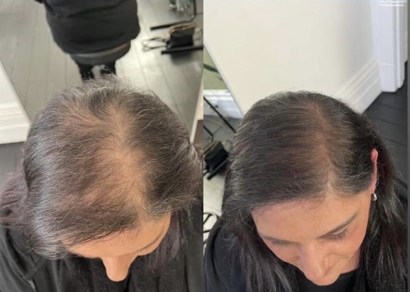SMP giving a woman fuller hair