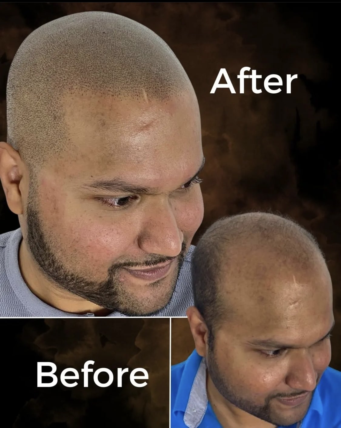 Before and after SMP treatment