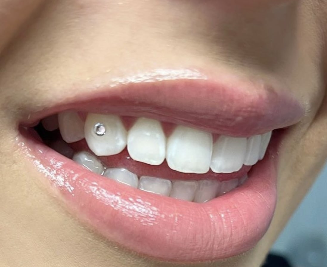 Whitened teeth with single tooth gem