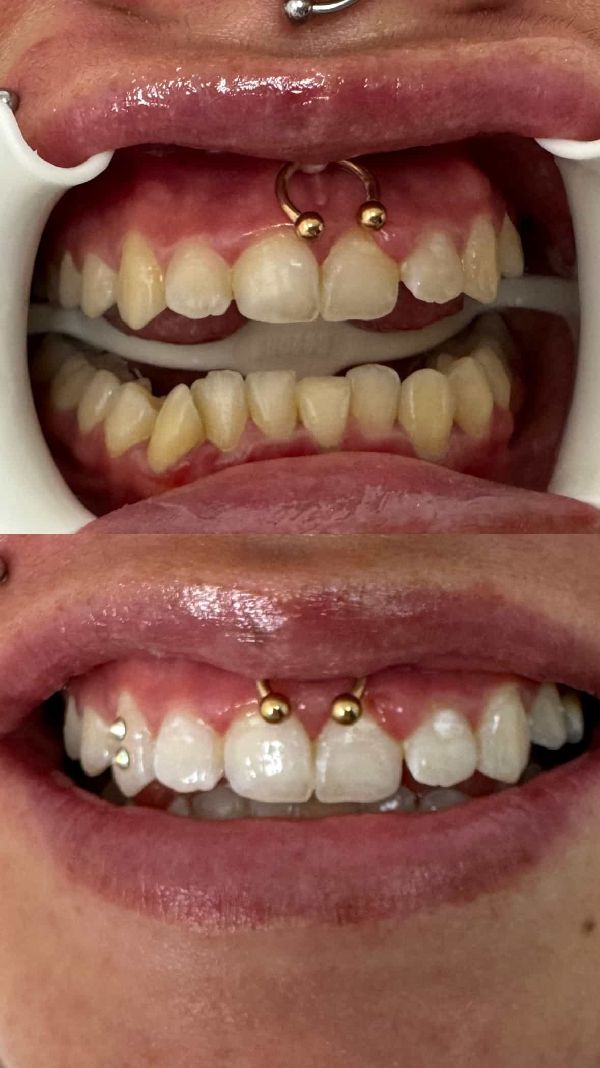 before and after teeth whitening at i-whiten