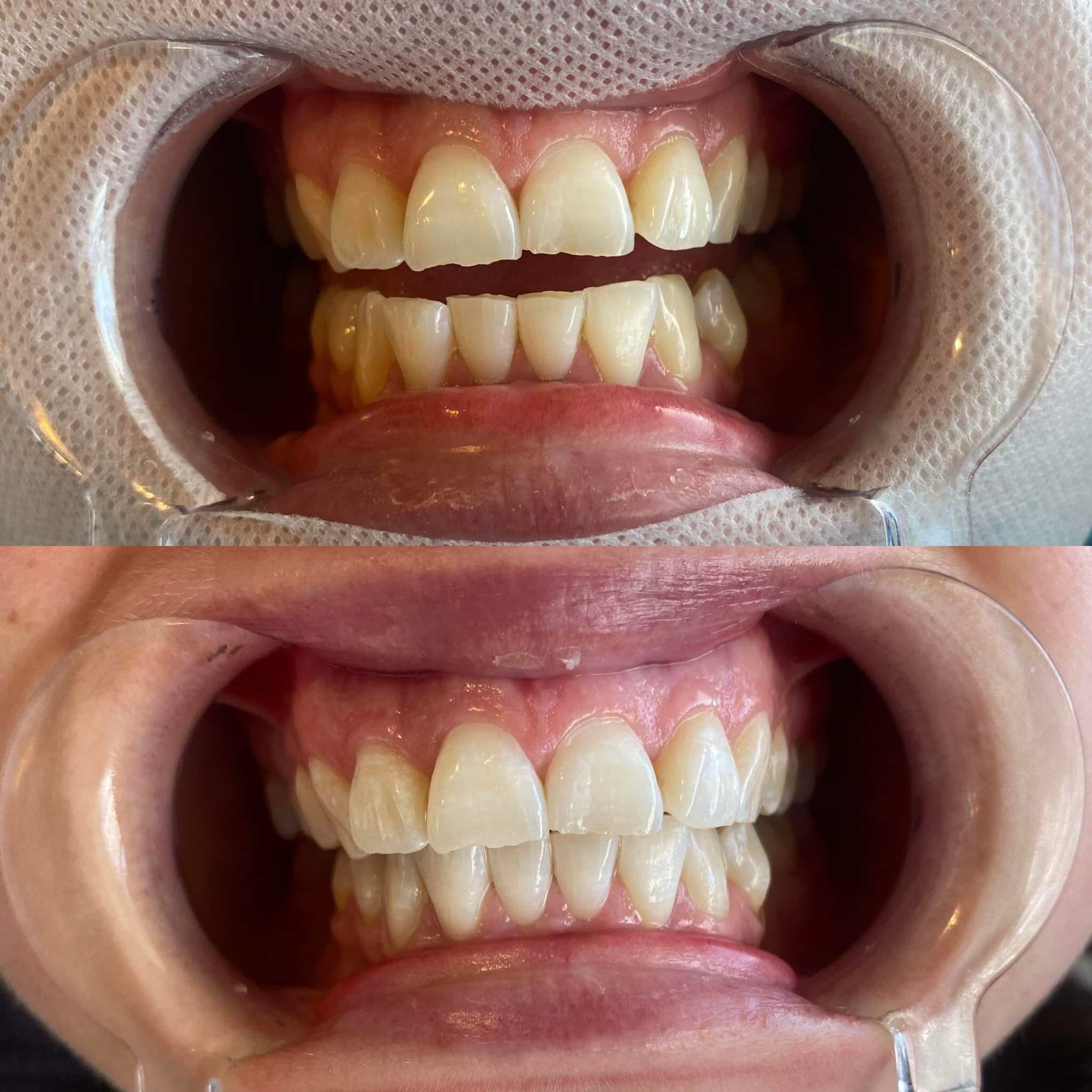 Close up of teeth before and after whitening