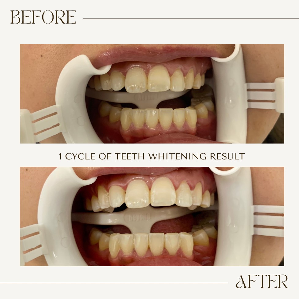 Close up of teeth after one session of whitening