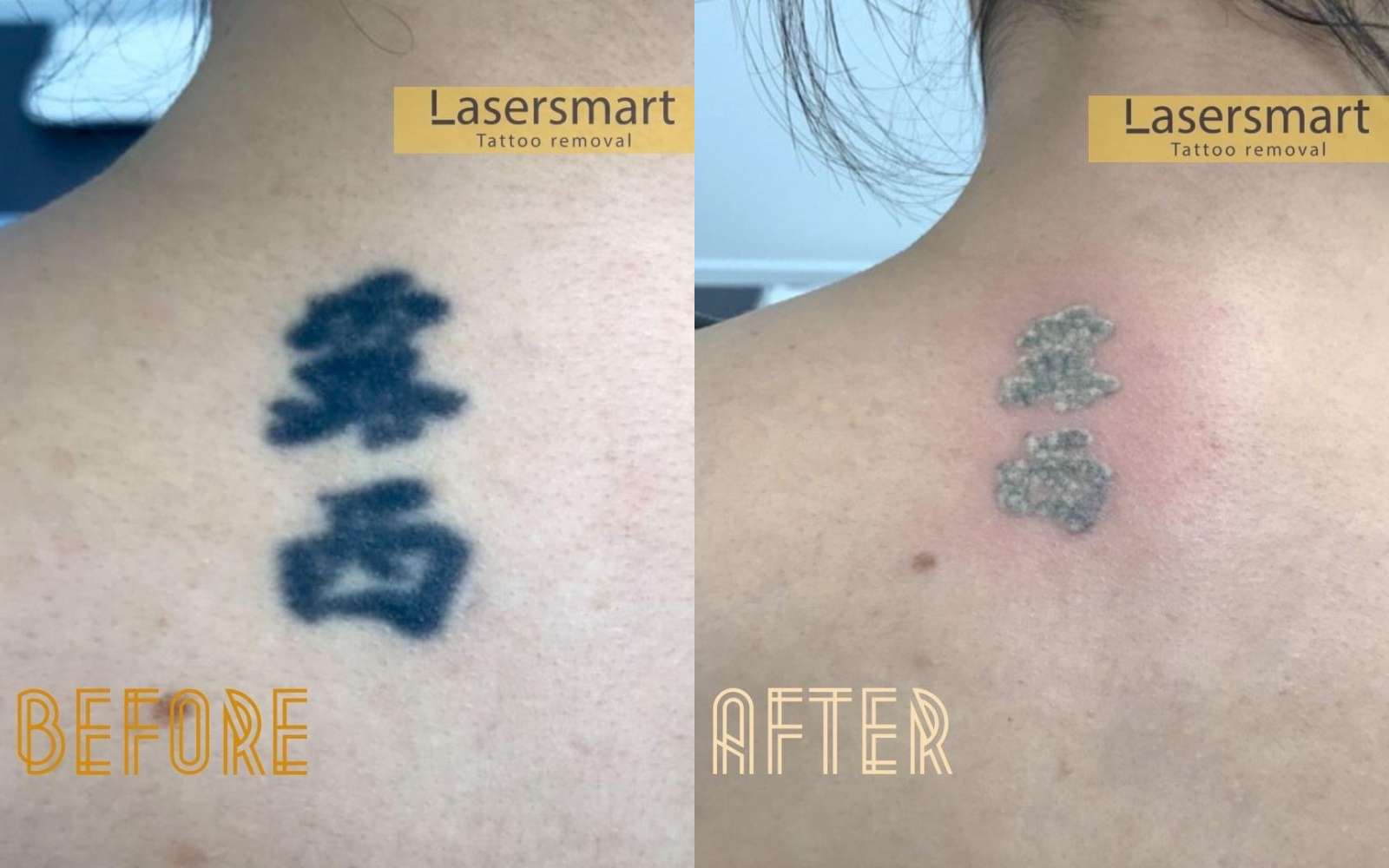Results from chinese character tattoo removal