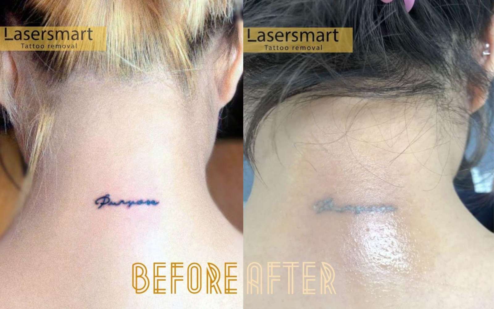 Results after a few sessions of laser tattoo removal on a small tattoo